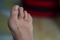 Choosing the Right Shoes for Hammertoes